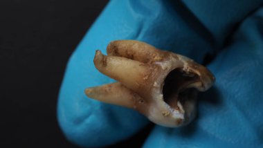 Tooth decay and dentist hand with glove and black background. Macro shot of a decayed teeth till root after extraction of dentist. Real tooth anatomy due lack of dental care. Top view of caries teeth