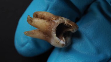 Tooth decay and dentist hand with glove and black background. Macro shot of a decayed teeth till root after extraction of dentist. Real tooth anatomy due lack of dental care. Top view of caries teeth