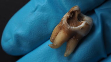 Tooth decay and dentist hand with glove and black background. Macro shot of a decayed teeth till root after extraction of dentist. Real tooth anatomy due lack of dental care. Top view of caries teeth