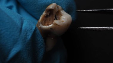 Tooth decay and dentist hand with glove and black background. Macro shot of a decayed teeth till root after extraction of dentist. Real tooth anatomy due lack of dental care. Top view of caries teeth