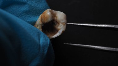 Tooth decay and dentist hand with glove and black background. Macro shot of a decayed teeth till root after extraction of dentist. Real tooth anatomy due lack of dental care. Top view of caries teeth