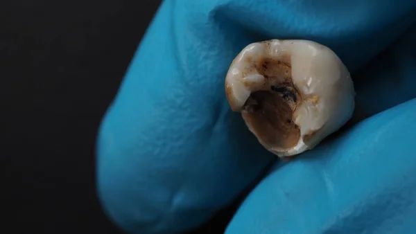 Tooth Decay Dentist Hand Glove Black Background Macro Shot Decayed Stockbild