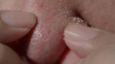 Ellerinle burnuna sivilce sıkıyorsun. Tıkanmış sivilceleri çıkarmak için bastırıyor ve sıkıyor. Cilt gözenekli sivilceleri kapatın. Burundan çıkan tıkanmış sivilceler. Cilt problemi kavramı.