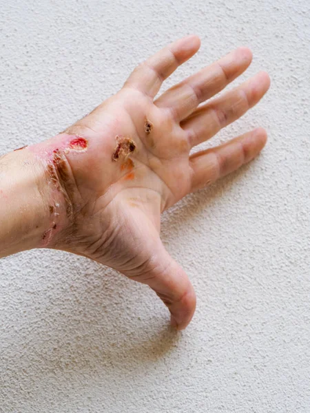 electric shock entry and exit wounds and burns in 50s adult caucasian man hand wrist healing and skin peeling after medical treatment.