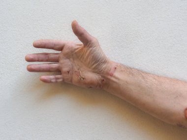 electric shock entry and exit wounds and burns in 50s adult caucasian man hand wrist healing and skin peeling after medical treatment.