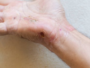 electric shock entry and exit wounds and burns in 50s adult caucasian man hand wrist healing and skin peeling after medical treatment.
