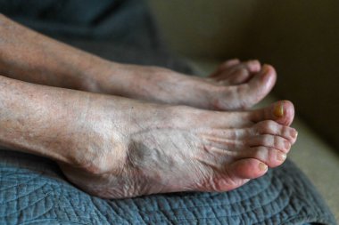 Sağlık sorunu olan yaşlı kadın ayağı, ostheo artrit iltihabı ve mantar.