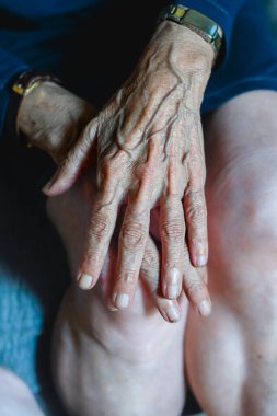 80 yaşındaki kadın elleri ostheo artrit, şişmiş eller ve parmak, eklem iltihabı, kıkırdaktaki bozulma tazminatı eksikliği yüzünden..