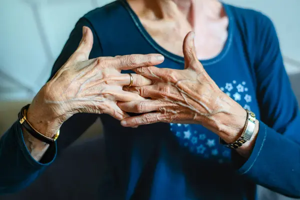 80 years old woman hands with ostheo arthritis, swollen hands and finger, joint inflammation, due to lack of cartilage of body deteriorarion compensation.