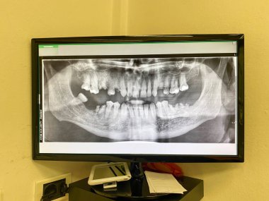 Piacenza, İtalya 15 Ekim 2024 Dijital diş panoramik radyografisi diş ve çene kemiğini dişçi muayenehanesinde teşhis ve tedavi için hazır halde gösteriyor.