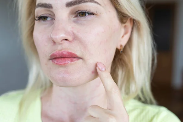白色背景下皮肤的真正生物修复作用 在妇女脸上注射生物修复剂的痕迹 生物修复针的痕迹 — 图库照片