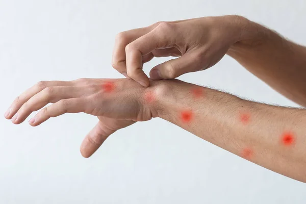 人们用手搔痒 变应性皮疹性皮炎患者皮肤湿疹 — 图库照片