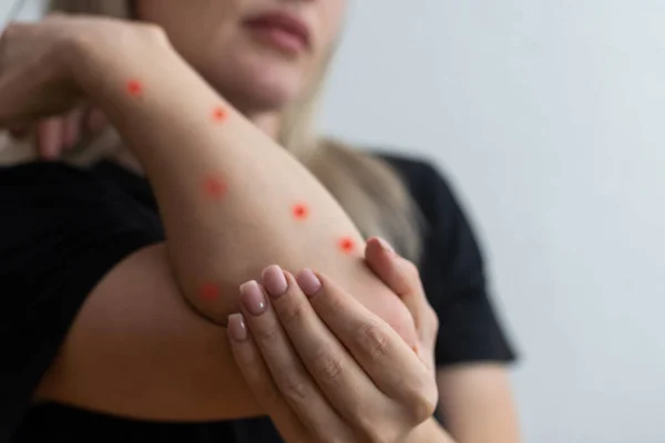 Ziek Allergische Uitslag Dermatitis Eczeem Huid Van Patiënt — Stockfoto