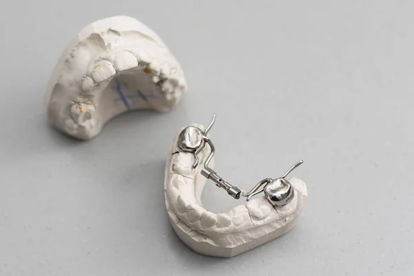 人間の顎の歯科鋳造石膏モデル 歯を砕き 遠口で噛んだ ブレースで治療する前に撮影されました 灰色の背景の技術的なショット — ストック写真
