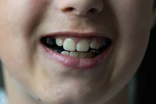 一个牙齿移位的小女孩露出了她的牙齿 — 图库照片