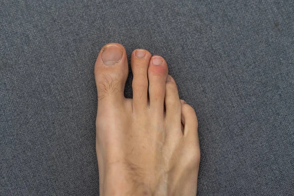 Young white male hairy foot with uncared toe nails.