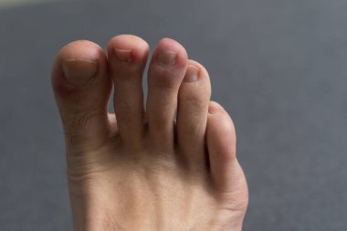 The foot, five toes, of a caucasian male with a damaged toe. Underneath the nail. small round cancerous spot. The small pimple like sore is melanin cancer