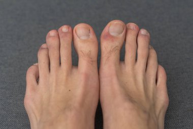 hair and wounds on male toes.