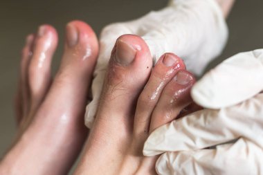 Kapkara parmaklar. Coronavirus belirtileri - şişkinlik ve renk değişimi, morumsu renk, acı ve pürüzlü deri.