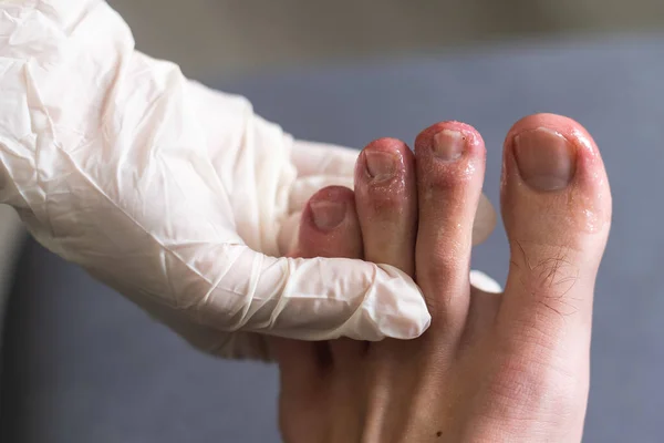 Covid Toes Bites Mans Toes — Stock Photo, Image