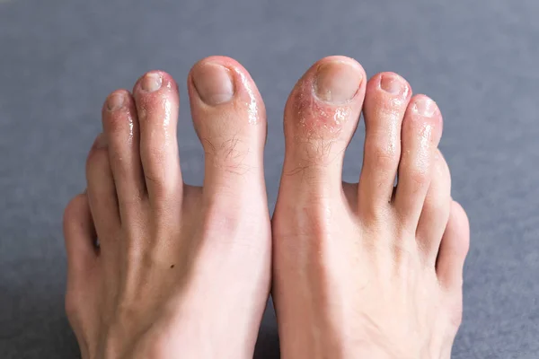 Covid Toes Bites Mans Toes — Stock Photo, Image