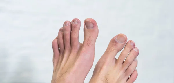 A mans toes showing what looks like a rash with red blotchy skin. A common side effect of Covid-19 often referred to as Covid toe