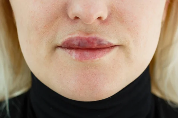 Kvinna Asymmetriska Läppar Som Ett Resultat Efter Läpp Augmentation Med — Stockfoto