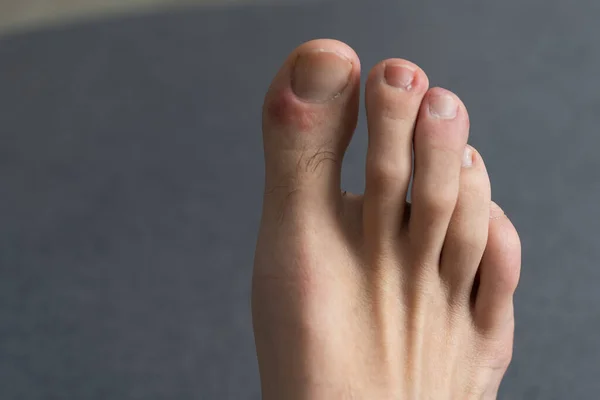 Hair Pimples Mens Toes — Stock Photo, Image