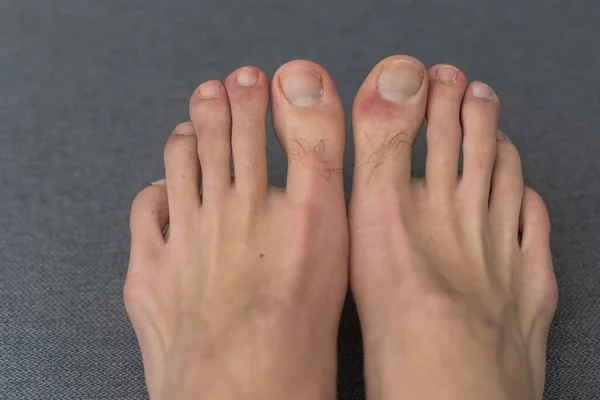 Erkeklerin Ayak Parmaklarında Kıl Sivilceler — Stok fotoğraf