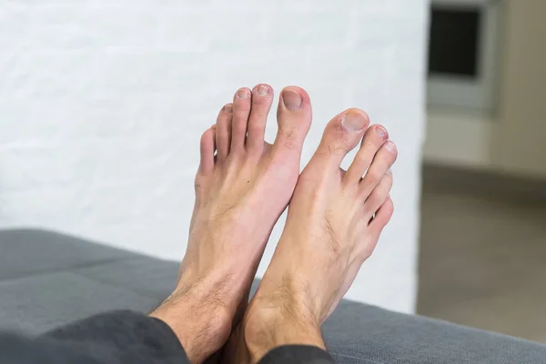 Білий Чоловік Тримає Пальці Ногах Показує Схоже Висипку Червоною Плямистою — стокове фото