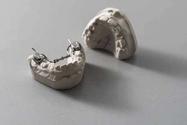 Modelo Yeso Fundición Dental Mandíbulas Humanas Dientes Torcidos Mordida Distal — Foto de Stock