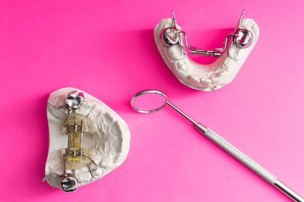 Colada Dental Yeso Modelo Yeso Fundido Estomatológico Mandíbulas Humanas Laboratorio — Foto de Stock