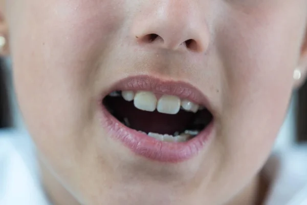 Una Bambina Con Una Dentizione Spostata Dimostra Suoi Denti — Foto Stock