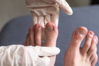 A mans toes showing what looks like a rash with red blotchy skin. A common side effect of Covid-19 often referred to as Covid toe