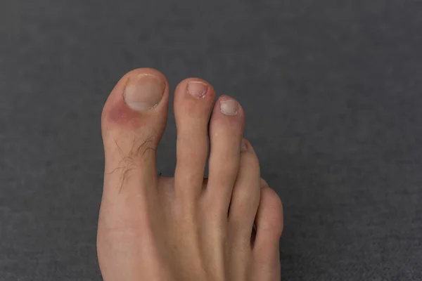 Hair Wounds Male Toes — Stockfoto