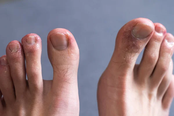 Mans Toes Showing What Looks Rash Red Blotchy Skin Common — Stock Photo, Image