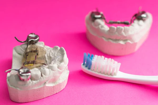 Płyta Dentystyczna Gipsowy Odlew Dziecięcej Szczęki Szczoteczki Zębów Niebieskim Tle — Zdjęcie stockowe