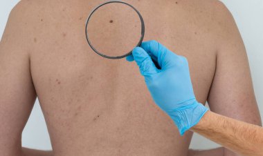 Dermatolog hastaların doğum lekelerini inceliyor. Kapalı alanda büyüteçle, yakından. Yüksek kalite fotoğraf