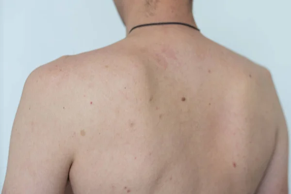 Corpo Masculino Com Vitiligo Manchas Brancas Pele Vitiligo Foto Alta — Fotografia de Stock
