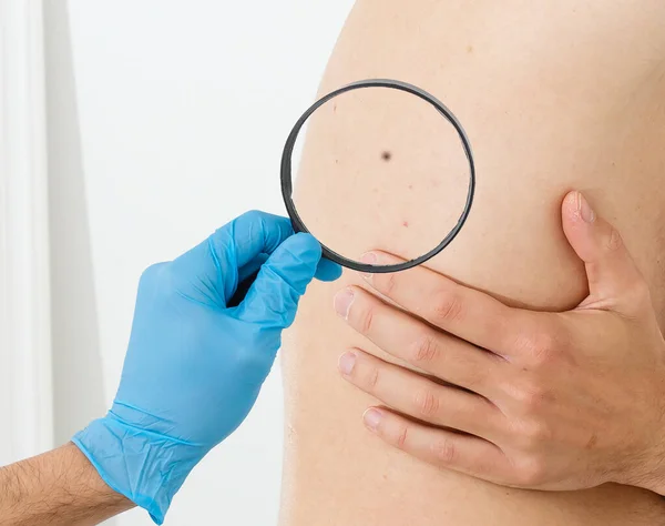 Orvos Megvizsgálja Kinövések Bőrön Egy Felnőtt Nagyító Diagnózis Bőrrák Hemangioma — Stock Fotó