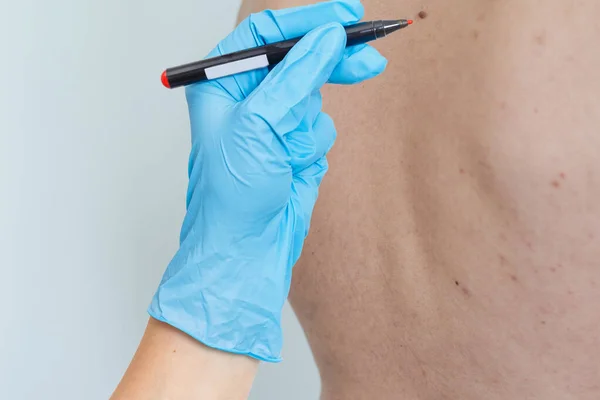 Manlig Kropp Med Vitiligo Vita Fläckar Huden Vitiligo Högkvalitativt Foto — Stockfoto