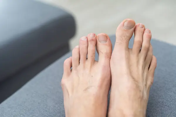 Young white male hairy foot with uncared toe nails.