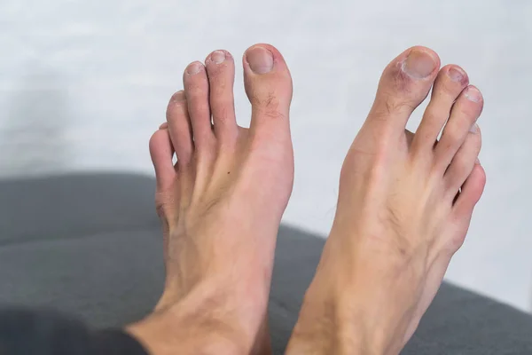 A mans toes showing what looks like a rash with red blotchy skin. A common side effect of Covid-19 often referred to as Covid toe