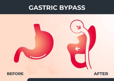 Roux-en-Y Gastrik Baypas (RNY) Kilo kaybı Cerrahi Vektör Çizim simgesi