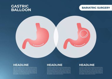 Mide Endoskopisi Gastrik Balon Bir mide ağırlığı kaybı cerrahi vektör ilüstrasyon obezite 