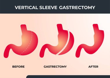 Laparoskopik Kollu Gastrectomy, Dikey Gastrectomy, Kilo kaybı, mide küçültme ameliyatı vektör ilülasyonu.
