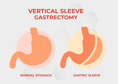 Laparoskopik Kollu Gastrectomy, Dikey Gastrectomy, Kilo kaybı, mide küçültme ameliyatı vektör ilülasyonu.