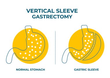 Laparoskopik Kollu Gastrectomy, Dikey Gastrectomy, Kilo kaybı, mide küçültme ameliyatı vektör ilülasyonu.