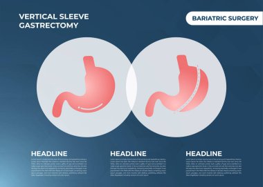 Laparoskopik Kollu Gastrectomy, Dikey Gastrectomy, Kilo kaybı, mide küçültme ameliyatı vektör ilülasyonu.