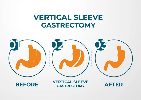 Laparoszkópos Hüvely Gastrectomia Vertikális Gastrectomia Testsúlycsökkentő Műtét Vektor Gyomorszűkítő Műtét — Stock Vector